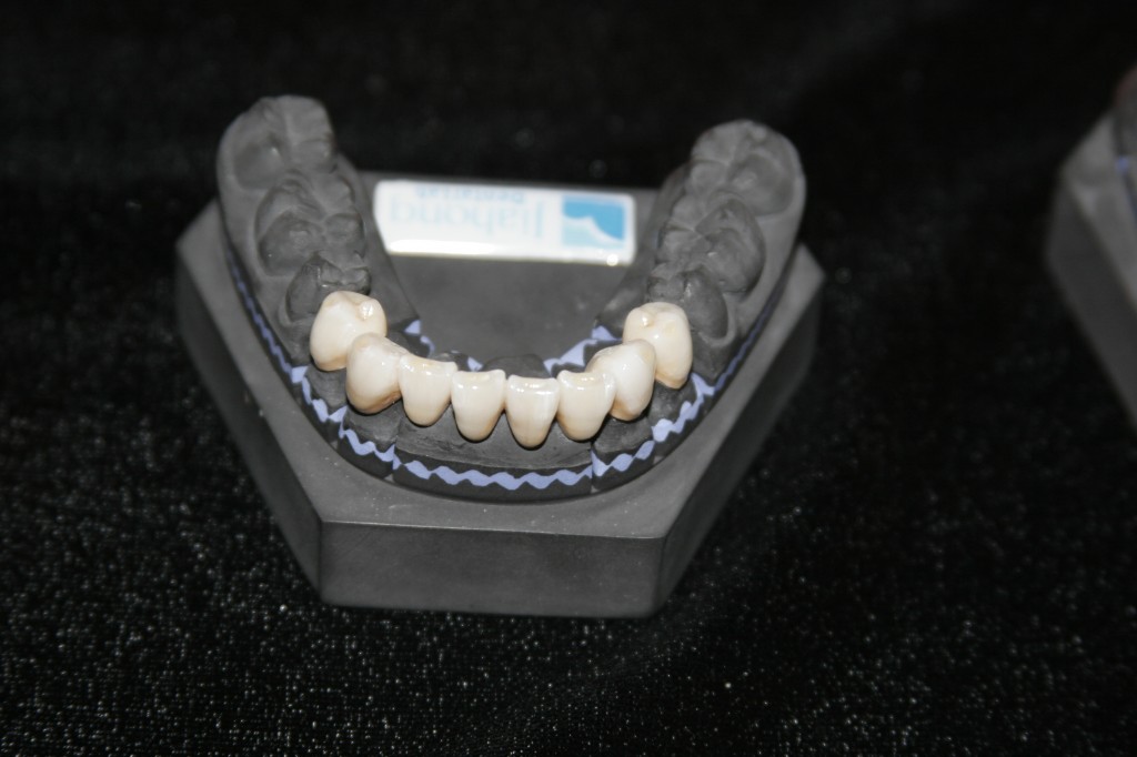 tru implant 1024x682 Những điều cần biết khi làm răng giả